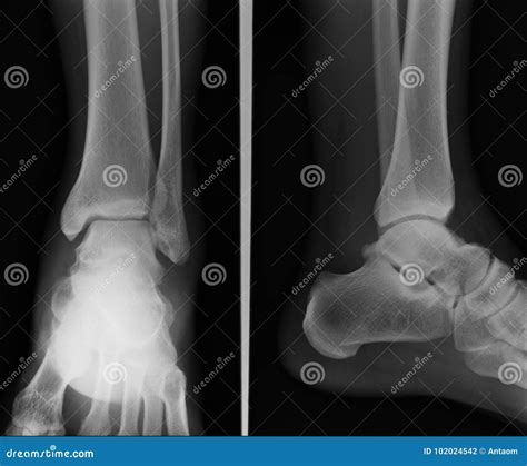 x ray ankle ap/lat
